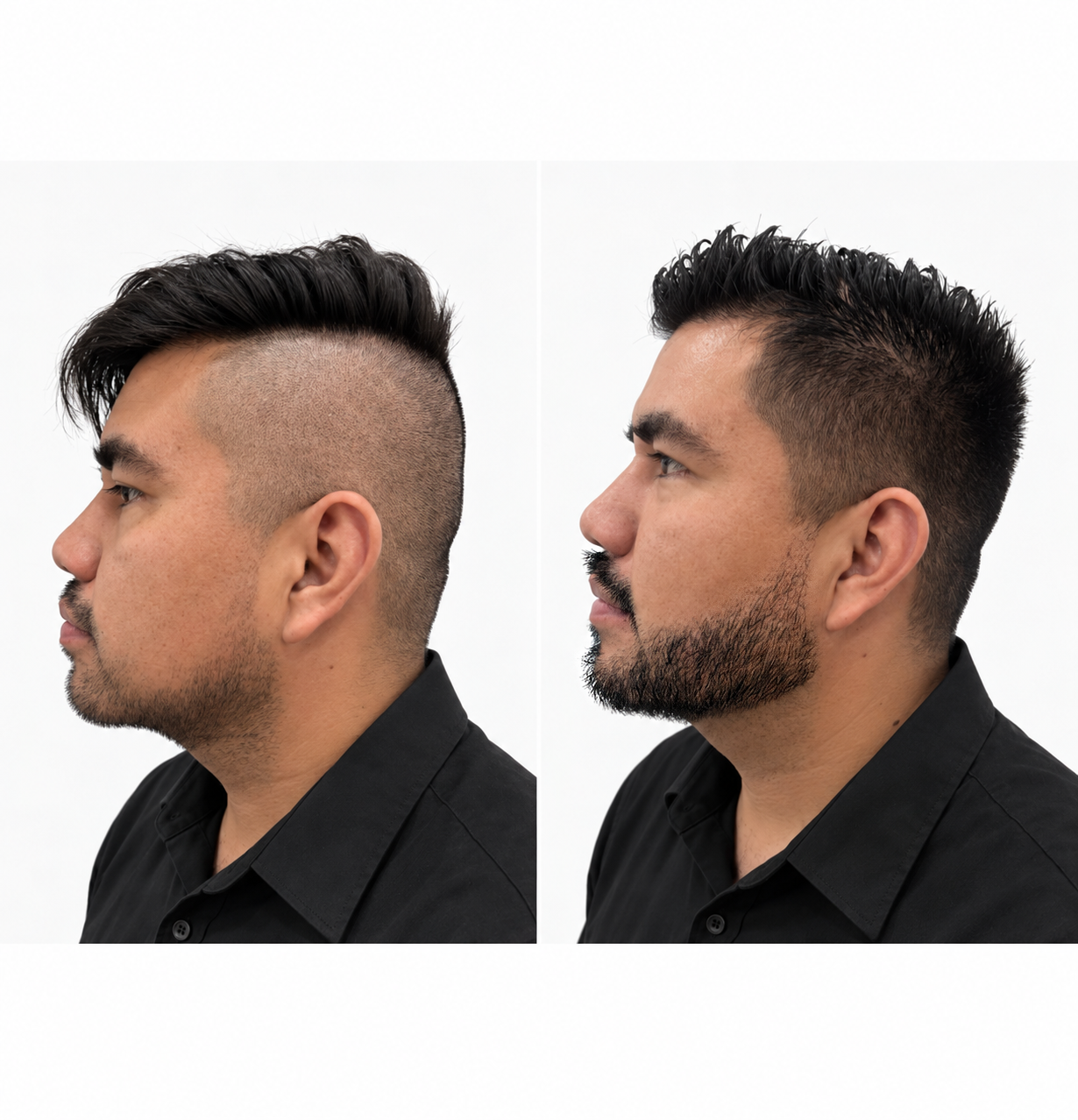 Waldo N., caso de injerto de barba